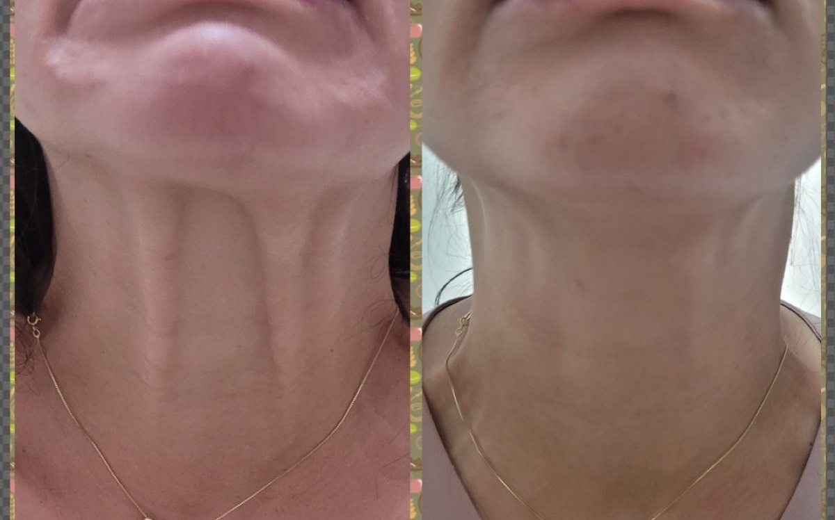 Resultado Rejuvenescimento Facial