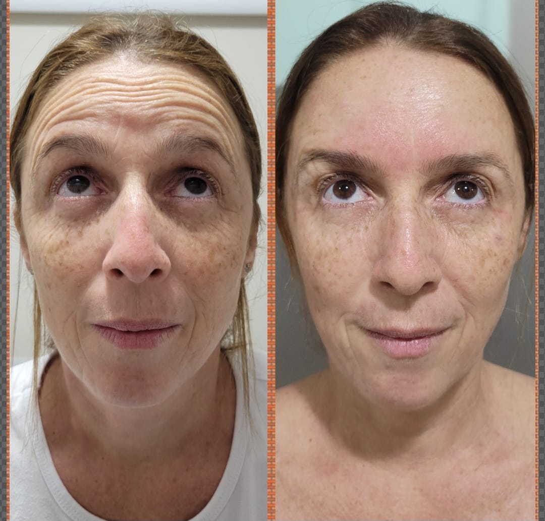 Resultado Rejuvenescimento Facial