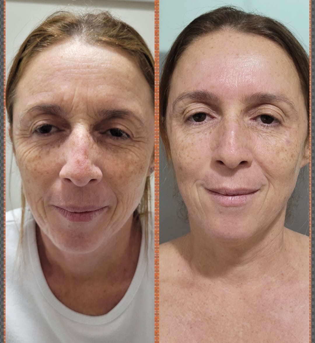 Resultado Rejuvenescimento Facial