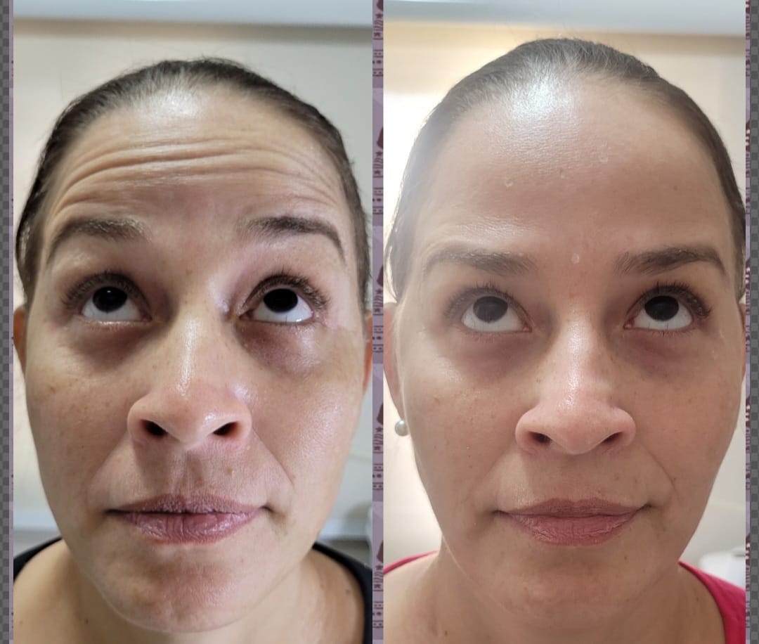 Resultado Rejuvenescimento Facial