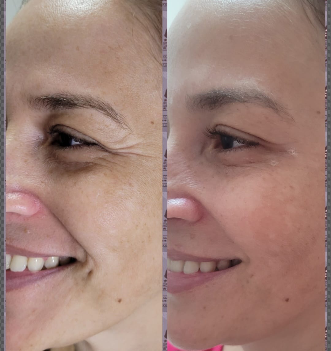 Resultado Rejuvenescimento Facial