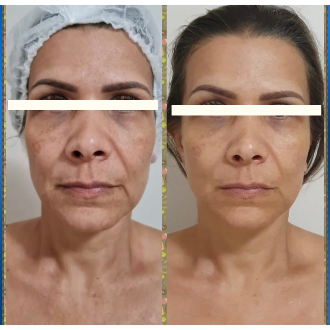 Resultado Rejuvenescimento Facial